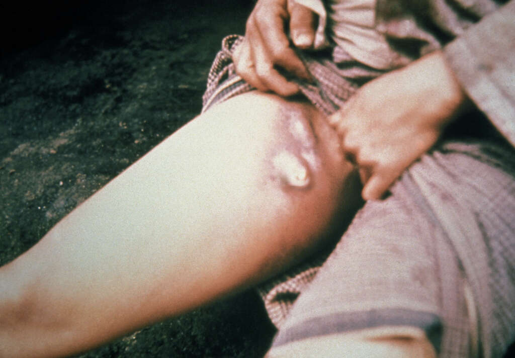 Bubonic Plague