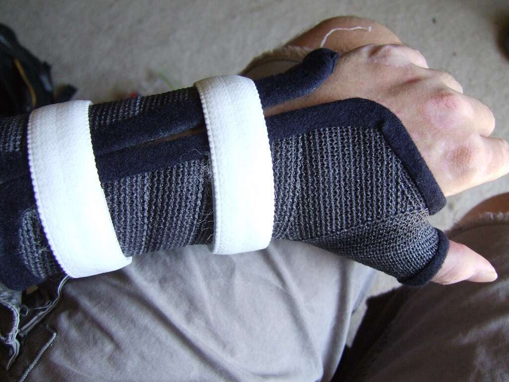 Wrist Cyst