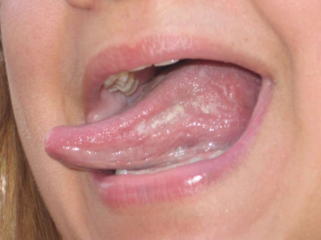 Yeast Infection